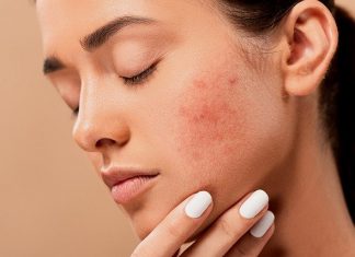 tratamientos naturales para el acné