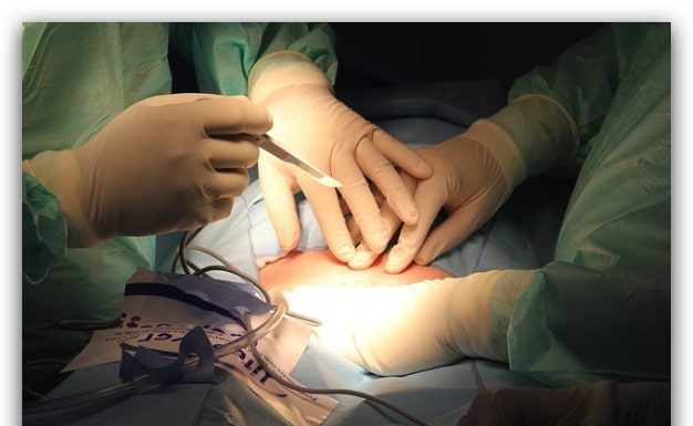 ¿Qué es la Mastopexia? Mastopexia